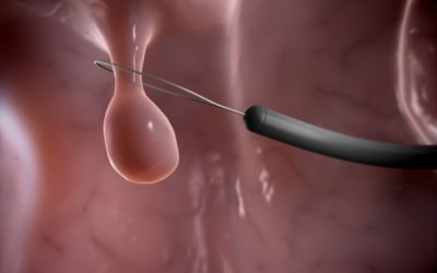 Metabiomics Concludes Colorectal Polyp Study with 232 Subjects Enrolled
